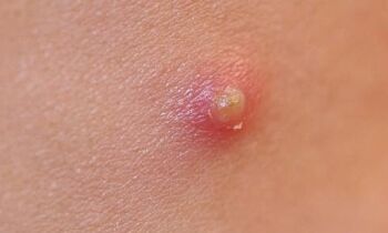acne sottopelle