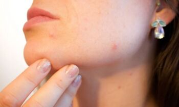macchie rosse sul viso