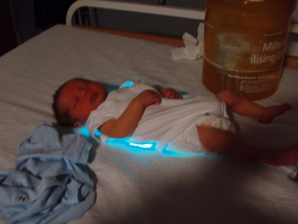 Un neonato curato con la fototerapia per l'ittero: la luce blu aiuta il corpo a eliminare la bilirubina. È uno dei pochi