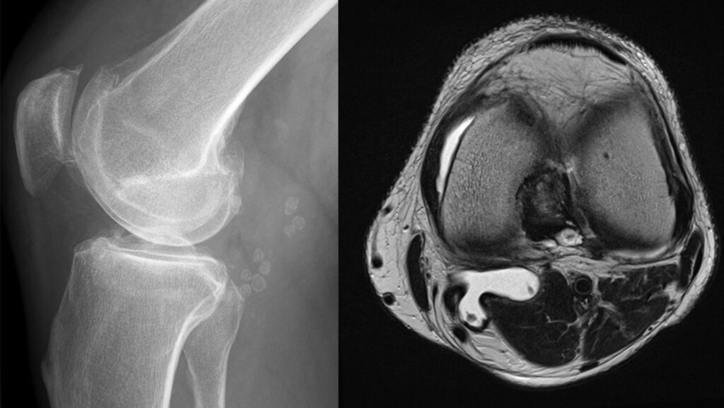 Una cisti di Baker vista con la radiografia e la risonanza magnetica (a destra): la sacca di liquido si trova nella part