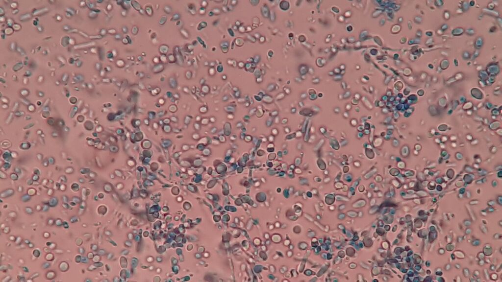 Il lievito Malassezia al microscopio: vive sul cuoio capelluto di tutti, ma in alcune persone scatena la forfora.